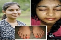فتاة هندية تبكي وتتعرق دما تجد علاجا بعد طول انتظار
