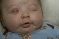 بالفيديو.. طفل أمريكى يولد بدون مقلتي عين !