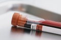 اختبار للدم يحدد الأشخاص المعرضين للإصابة بالزهايمر