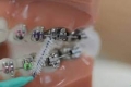 10 معلومات عليك معرفتها قبل تركيب تقويم للأسنان