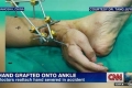أطباء يُنقذون يد مريض من البتر ويزرعونها بكاحل قدمه