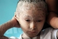 بالصور... مرض جلدي نادر يحول طفلاً إلى &quot;سمكة&quot;