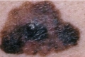 باحثون: سرطان الجلد قادر على مقاومة جهاز الجسم المناعي