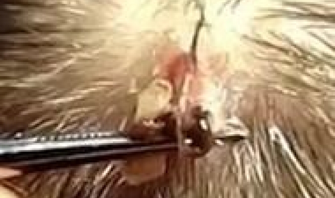 بالفيديو: إخراج حشرة ضخمة من رأس رجل