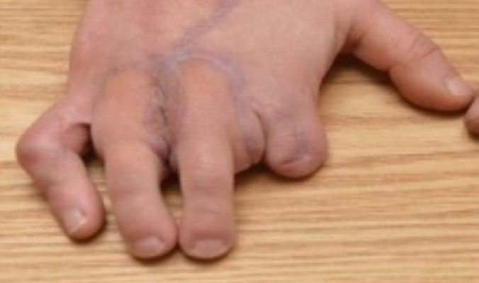 بالصور: شاب يستبدل أصابع يديه بأصابع قدميه