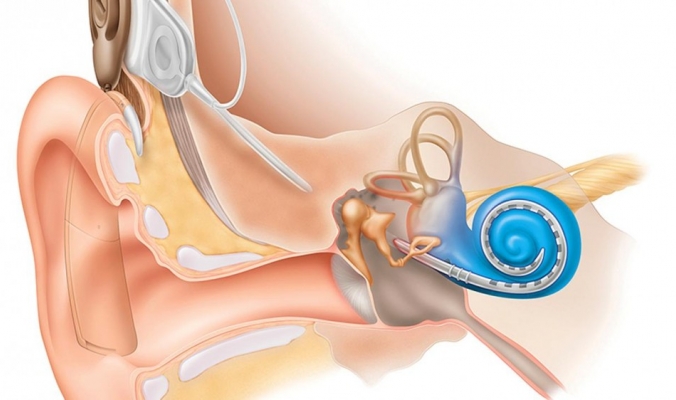 دراسة: فقدان السمع قد يكون عاملا مسببا للخرف