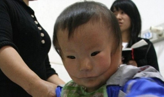 طفل صيني بوجهين يصدم الأطباء في حالة نادرة