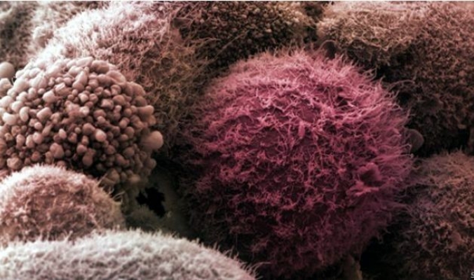 ثورة في علاج سرطان البنكرياس