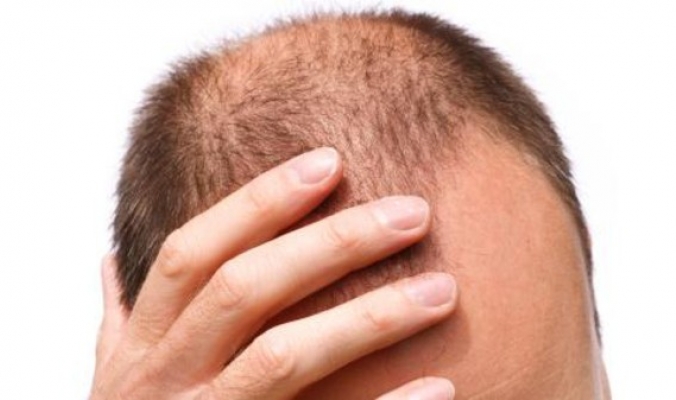 ماذا يحدث للأصلع بعد زراعة الشعر؟