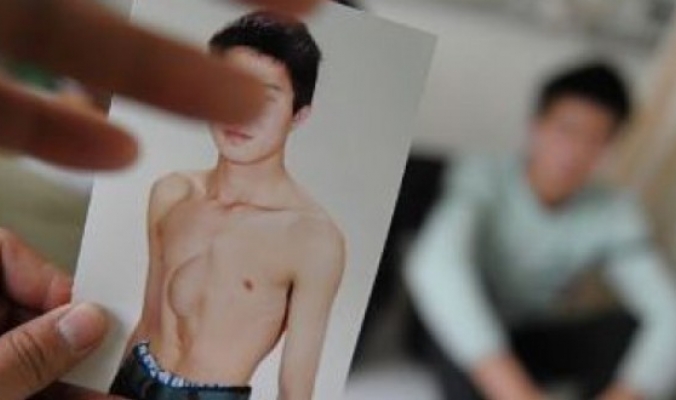 بالصور: شاب صيني يعيش 24 سنة وقلبه في “بطنه”