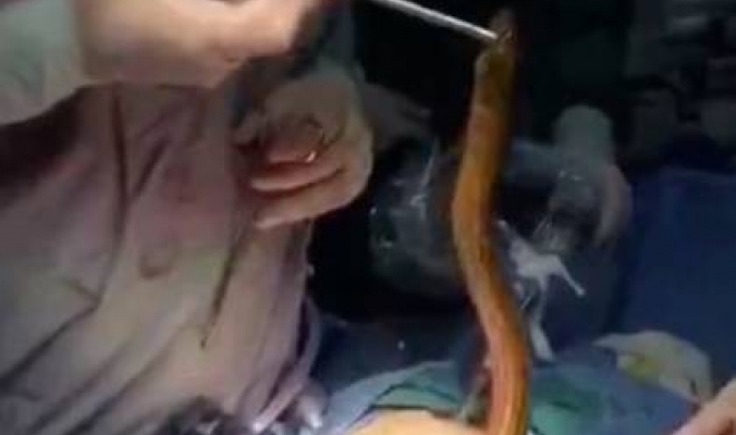 فيديو: استخراج ثعبان من جسم مريض .. لكن كيف وصل الى هناك؟
